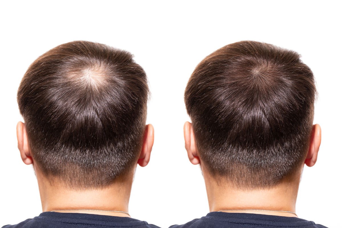 Top-Rated Hair Transplant UK Clinic with Proven Success Stories