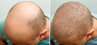 Hair Transplant Istanbul: Your 2025 Guide to Affordable Excellence